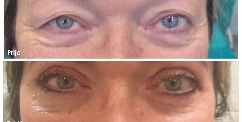 Blefaroplastika -56% Centar