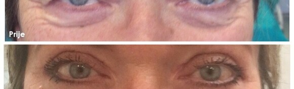 BLEFAROPLASTIKA - obrišite tragove umora s lica uz korekciju gornje ili donje vjeđe oba oka i riješite problem spuštenih kapaka i vrećica ispod očiju u Poliklinici Superiora