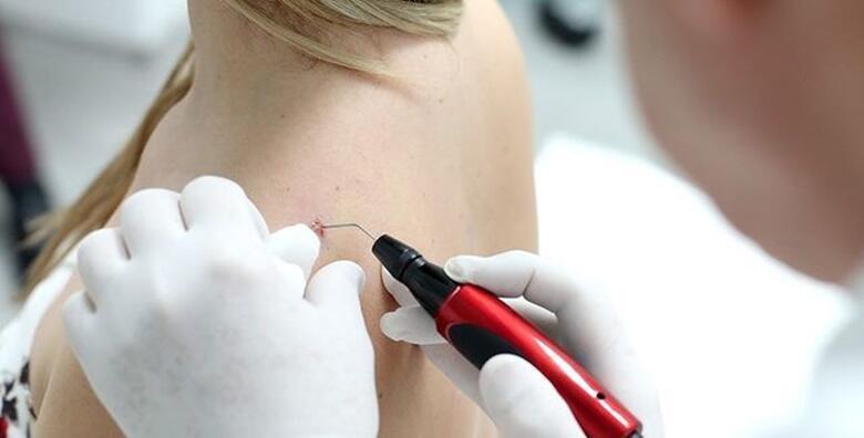 Uklanjanje Koznih Promjena Uklonite Madeze Bradavice Ili Lipome Do 1 Cm Uz Lokalnu Anesteziju U Poliklinici Ribnjak Uklanjanje Koznih Promjena Uklonite Madeze Bradavice Ili Lipome Do 1 Cm Uz Lokalnu Anesteziju U Poliklinici Ribnjak