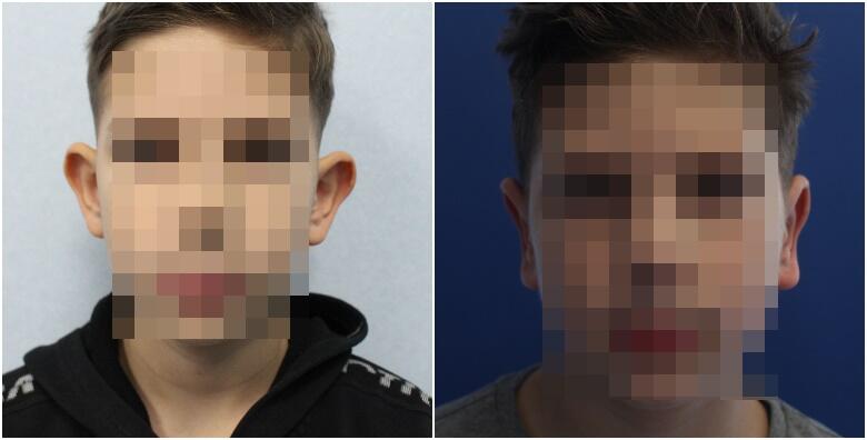 Estetska korekcija ušiju u Poliklinici Ageless Medical Aesthetic za 4.550 kn!