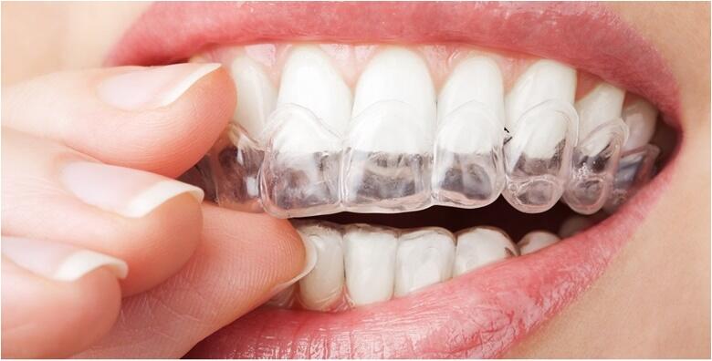 POPUST: 33% - Prozirni aparatić za zube za 1 čeljust - najsuvremenijom ponudom stomatološke struke postignite zdrav i lijep osmijeh za 3 do 9 mjeseci uz uključenu dijagnostiku za 7.999 kn! (IMPLANT EXPERT)