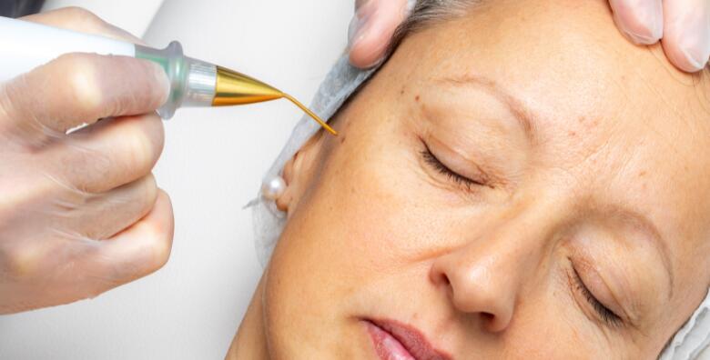 Uklanjanje bradavice, keratoze ili fibroma inovativnim tretmanom PLASMA PEN - najefikasniji način uklanjanja bradavica u Bio+klinik kozmetičkom salonu