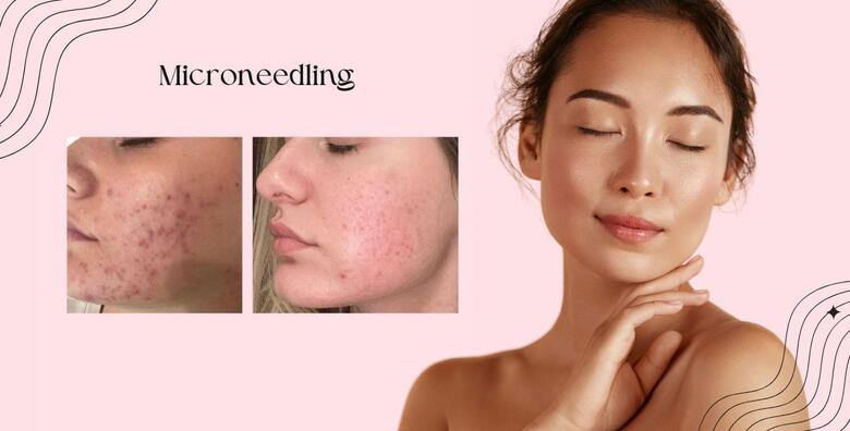 Microneedling + kemijski piling -54%