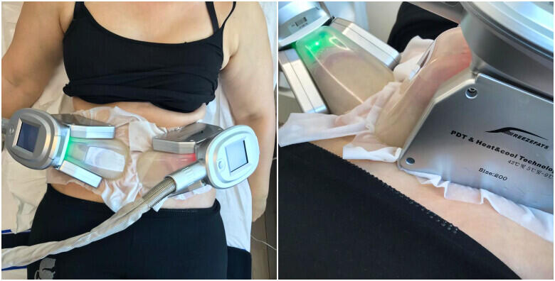 Uklonite i zamrznite masne stanice uz HIT revolucionarni tretman KRIOLIPOLIZE + limfna drenaža u salonu za njegu tijela OzonM