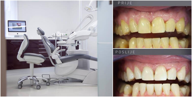 Izbjeljivanje zubi -50% Malešnica