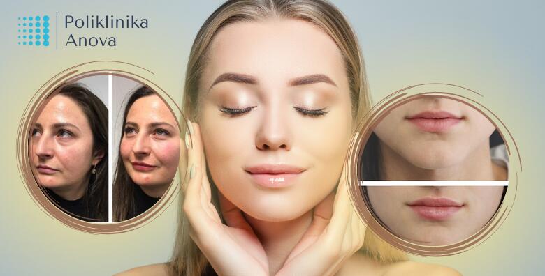 Teoxane 1 ml + botox do 100 jedinica