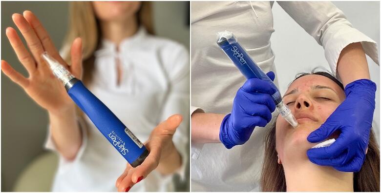 SkinPen tretman za PRIRODNO POMLAĐIVANJE! Uređajem za microneedling poboljšajte izgled ožiljaka od akni i izgled finih linija bora na licu i vratu u Ordinaciji Dent Natura
