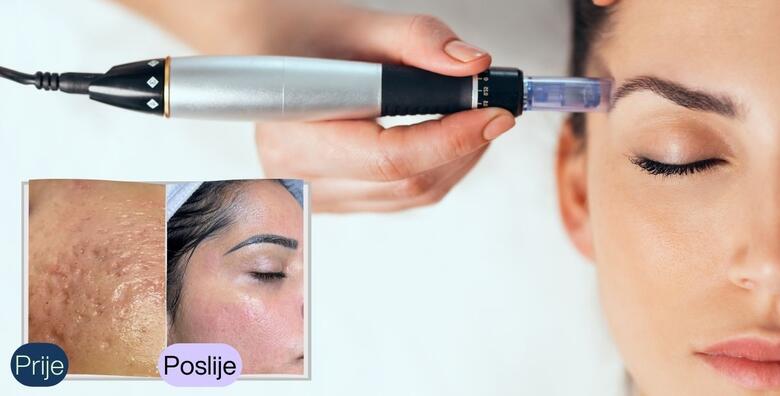 Dermapen microneedling -44%