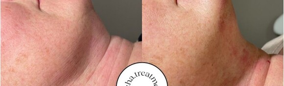 2 tretmana podbratka TECAR uređajem - zategnite kožu bez odlaska pod nož uz brze rezultate te dugotrajne učinke u Acha Treatments Salonu