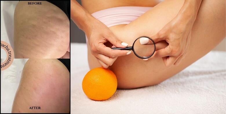 POBJEDITE CELULIT TECAR UREĐAJEM! Bezbolan tretman uklanjanja celulita i masnih naslaga na rukama, nogama ili trbuhu u Acha Treatments Salonu