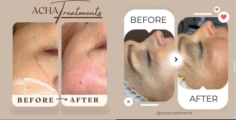 Uklanjanje bora ili podbratka TECAR uređajem – zategnite kožu bez odlaska pod nož uz brze rezultate i dugotrajne učinke u Acha Treatments Salonu