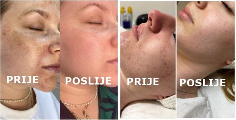 Smanjite vidljivost akni, bora i ožiljaka te potaknite proizvodnju kolagena uz paket od 5 tretmana DERMAROLLERA u Beauty Studiju Dora Secret
