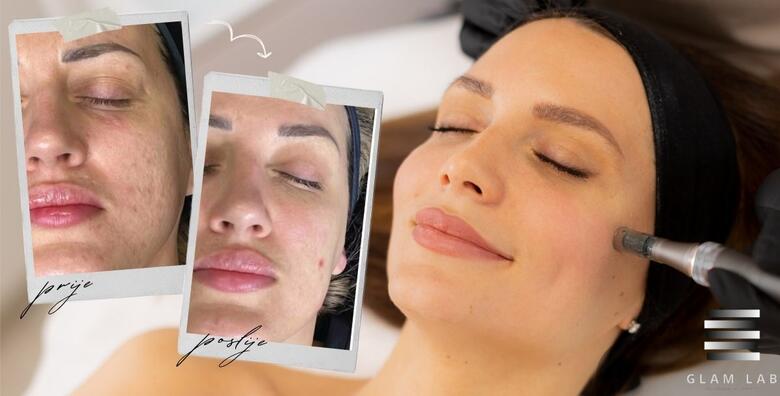 Edukacija microneedling – upoznajte se sa tehnikama uklanjanja ožiljaka od akni i tamnih mrlja sa kože jednodnevnom edukacijom u trajanju od 6 sati u Glam Lab-u