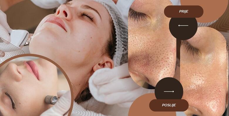 Ultrazvučno čišćenje lica špatulom uz njegu lica pilingom, maskom i masažom te dijamantna mikrodermoabrazija u Glam Lab-u