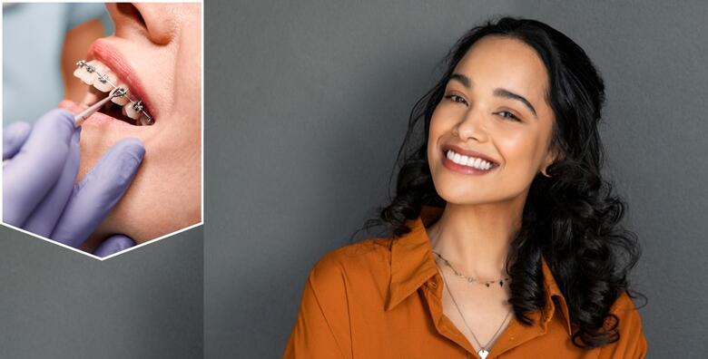 Fiksni aparatić za jednu čeljust uz uključene sve preglede i kontrole u Specijalističkoj ordinaciji dentalne medicine za ortodonciju Dinko Čotić