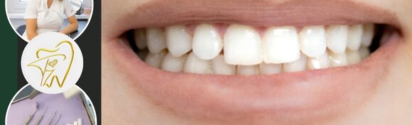Čišćenje kamenca, pjeskarenje i fluoridacija zubi u Ordinaciji dentalne medicine Tijana Župan,dr.med.dent.